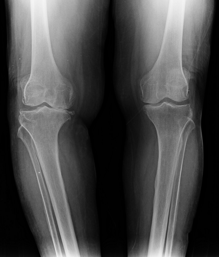 Read more about the article מדרסים לכאבי ברכיים: הקשר המפתיע והפתרונות האפשריים מחקרים