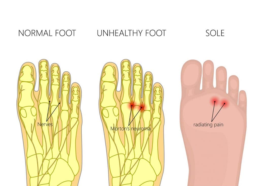 מדרסים למורטון ניורומה