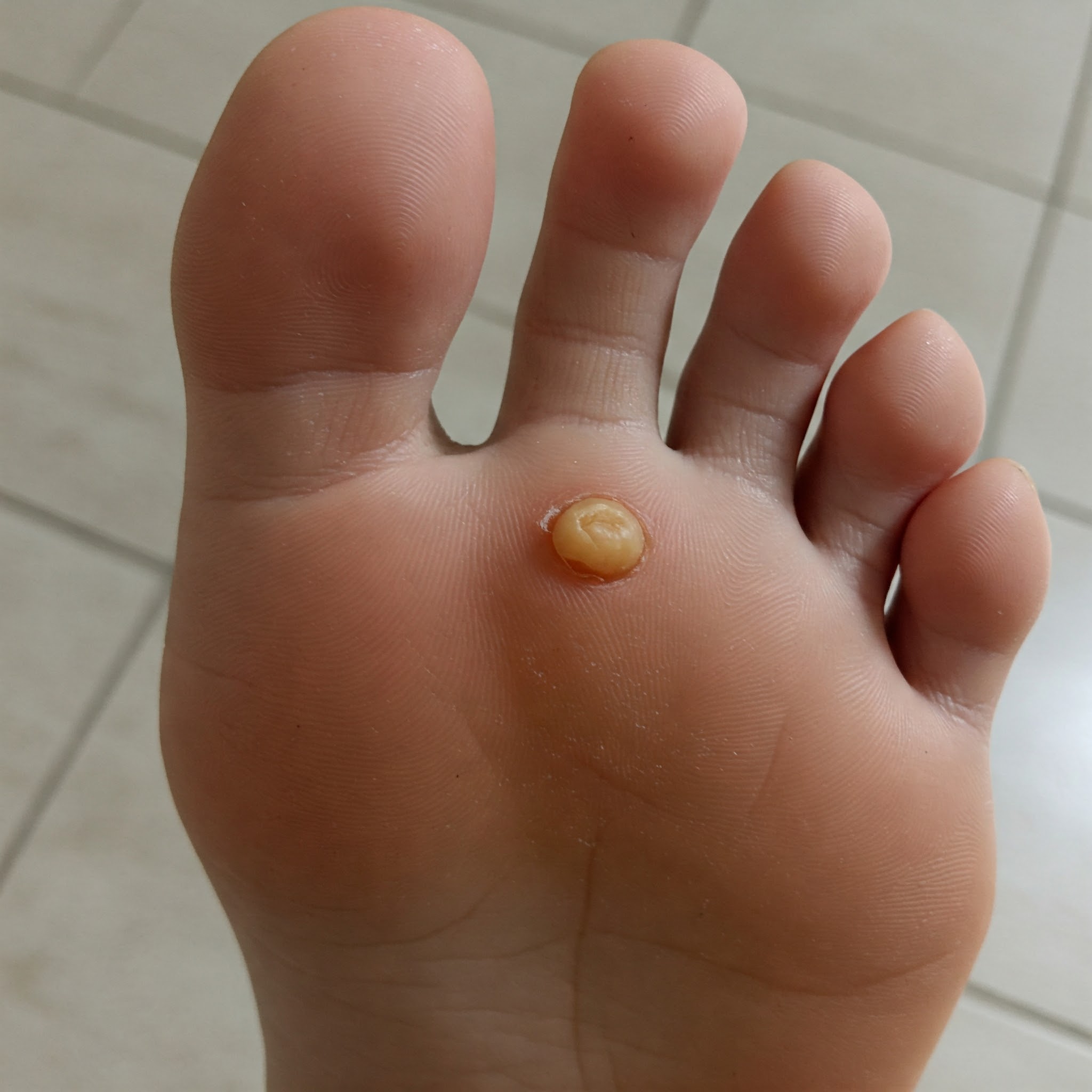 Read more about the article יבלות בכפות הרגליים גורמים טיפול ומניעה באמצעות מדרסים מותאמים אישית